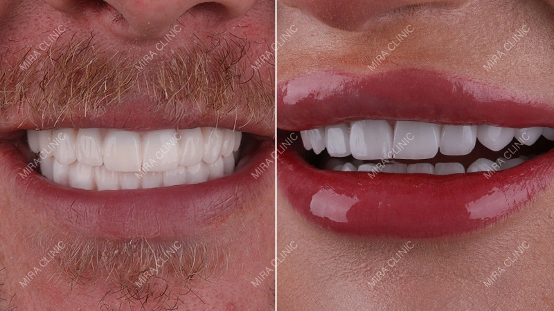 Crowns vs Veneers for Front Teeth